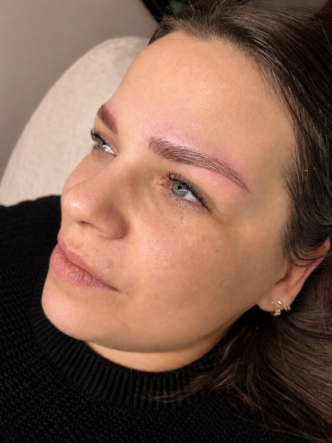Brow Lifting